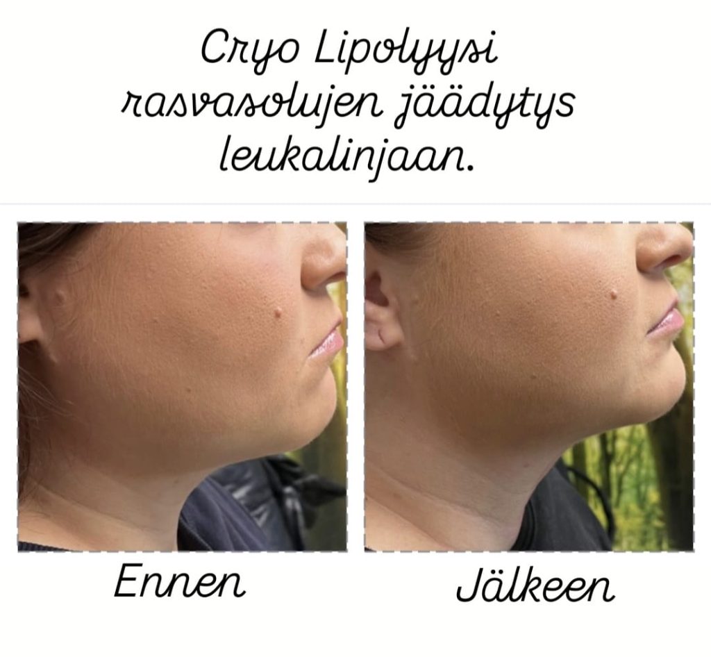Cryo Lipolyysi leukalinjaan