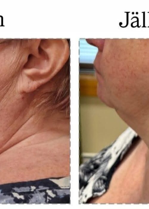 Koko kasvot ja kaula antiagehoito