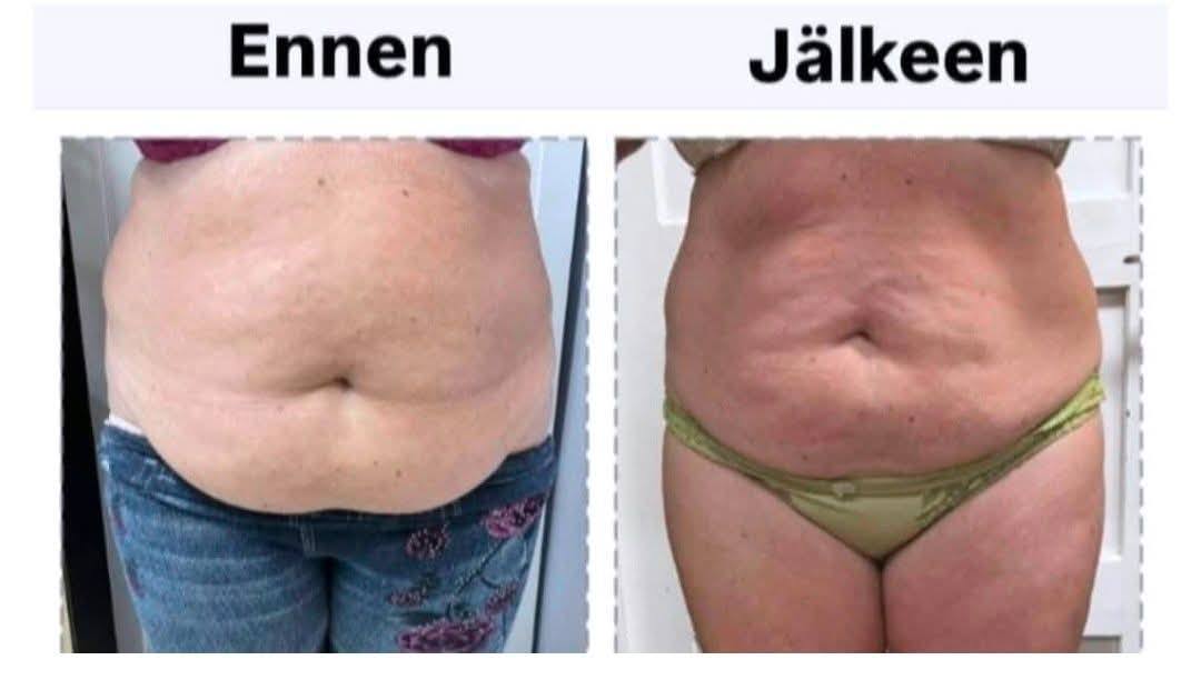 Cryo lipolyysi vuoden muuttuja rasvasolujen jäädytys Hyvän Olon Aitta kauneushoitola Hämeenlinna
