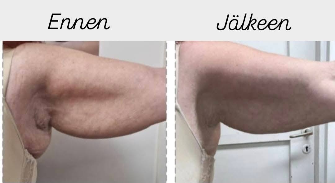 Hifu alleille vuoden muuttuja Hyvän Olon Aitta kauneushoitola Hämeenlinna