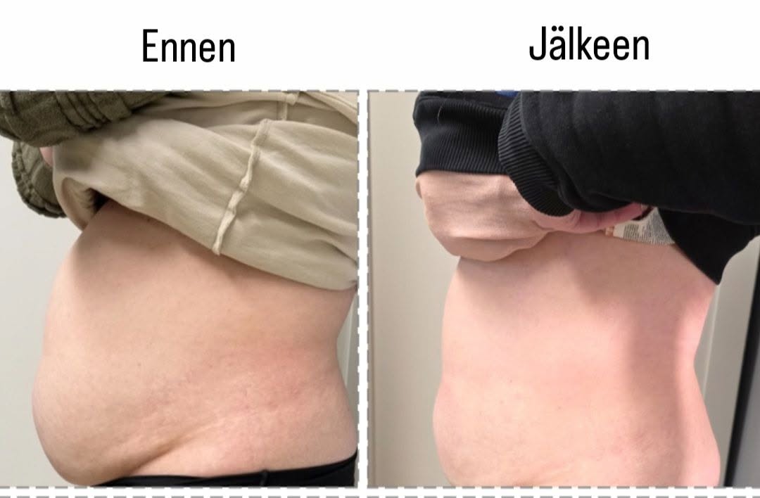 Cryo lipolyysi rasvasolujen jäädytys ja Lipolaser Hyvän Olon Aitta kauneushoitola Hämeenlinna.