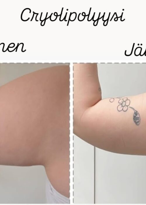 Cryo Lipolyysi ja Lipolaser käsivarsiin.