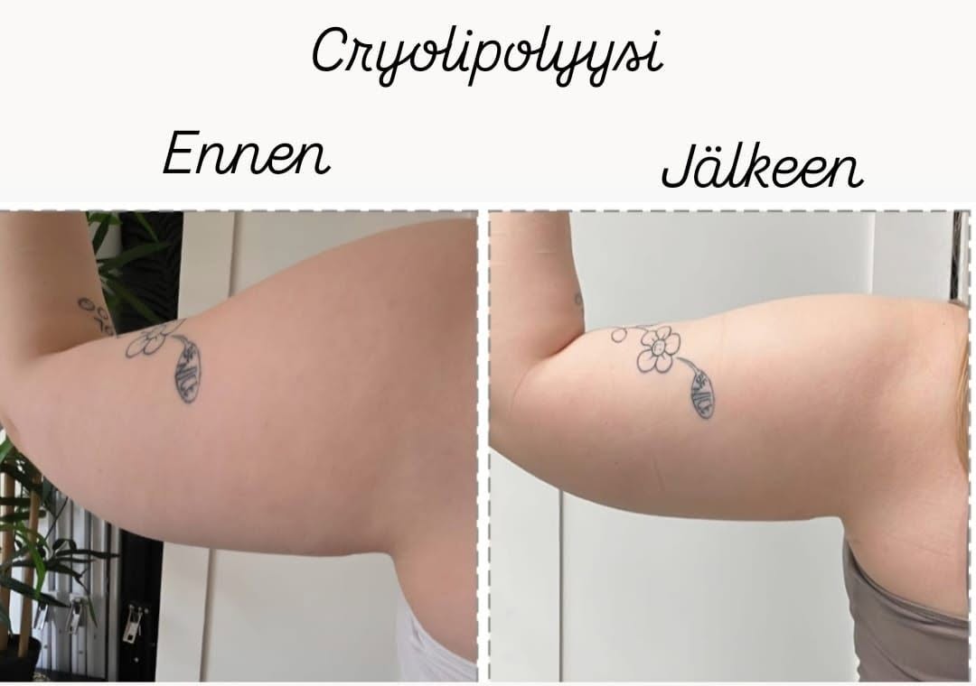 Cryoliplyysi ja Lipolaser käsivarsiin Hyvän Olon Aitta kauneushoitola Hämeenlinna.