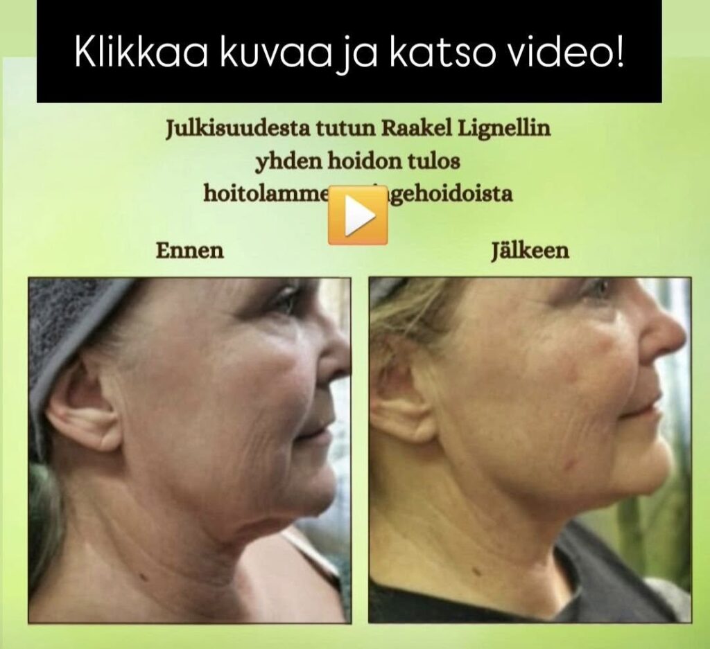 Hifu kasvojenkohotus kokemuksia ja tuloksia Raakel Lignell Hyvän Olon Aitassa kauneushoitola Hämeenlinna.